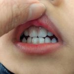 【2歳半歯科検診】初期虫歯かと思いきや着色と歯石でした
