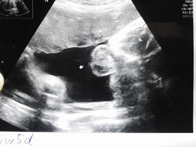妊娠37週のエコー写真
